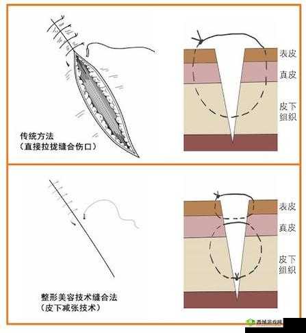 竹板打肿臂缝合不上：为何如此严重